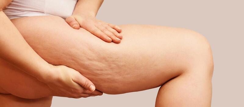 celulitis-comprension-y-abordaje-integral-pierna